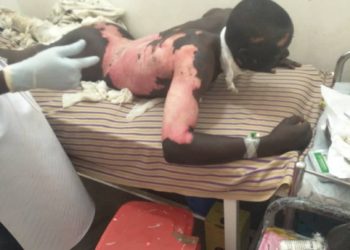 Two Male Sunbelt Factory Jinja Casual Laborers Electrocuted, Company abandons them in private clinic