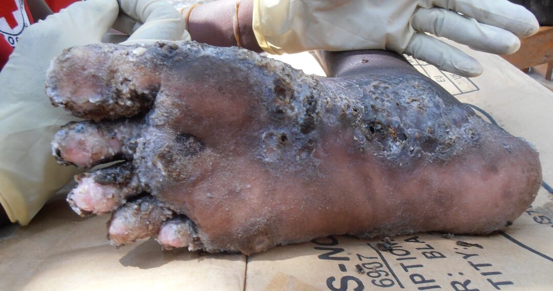 “We Don’t Have Medicines”: Jiggers Ravage a Landing Site In Apac, Over 160 Affected