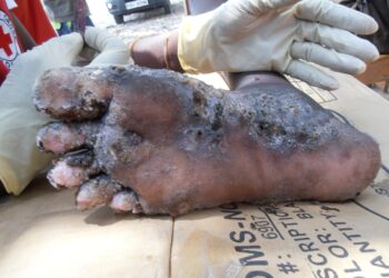 “We Don’t Have Medicines”: Jiggers Ravage a Landing Site In Apac, Over 160 Affected