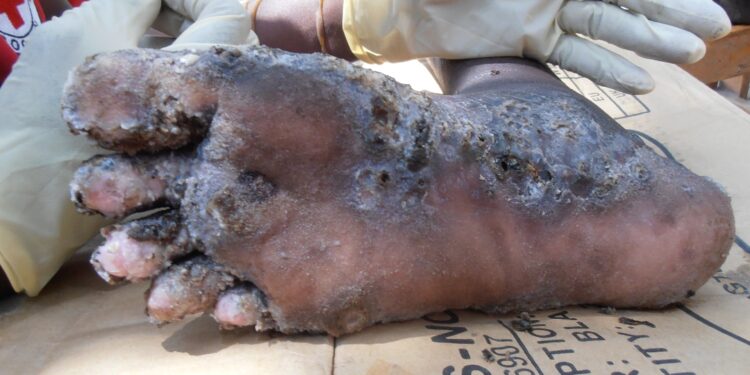 “We Don’t Have Medicines”: Jiggers Ravage a Landing Site In Apac, Over 160 Affected